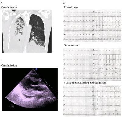 Case Report: Acute Myocarditis Due to PD-L1 Inhibitor Durvalumab Monotherapy in a Patient With Lung Squamous Cell Carcinoma